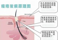 痤瘡治療的誤區(qū)有什么？痤瘡的治療要警惕哪些